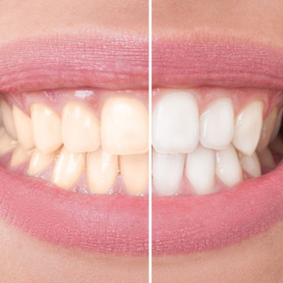 Sistema de Blanqueamiento DenticWabb